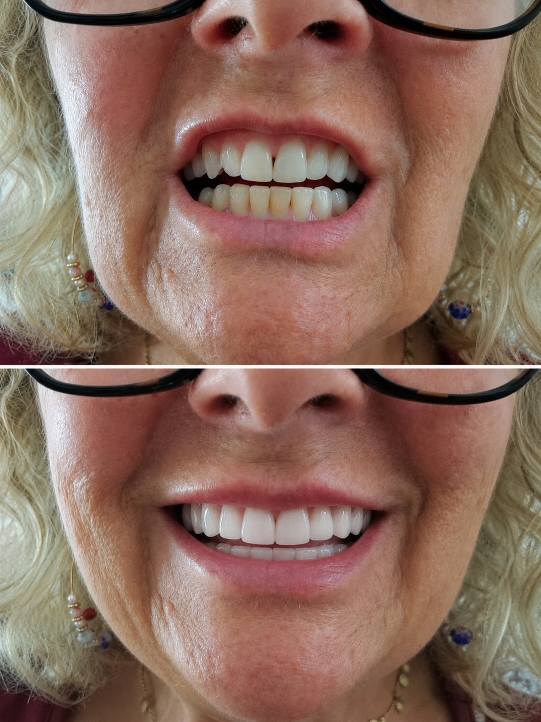 PRAXIS MILL restorative result