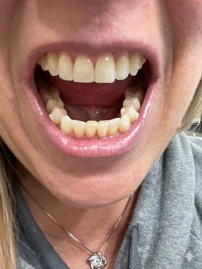 PRAXIS MILL restorative result — before